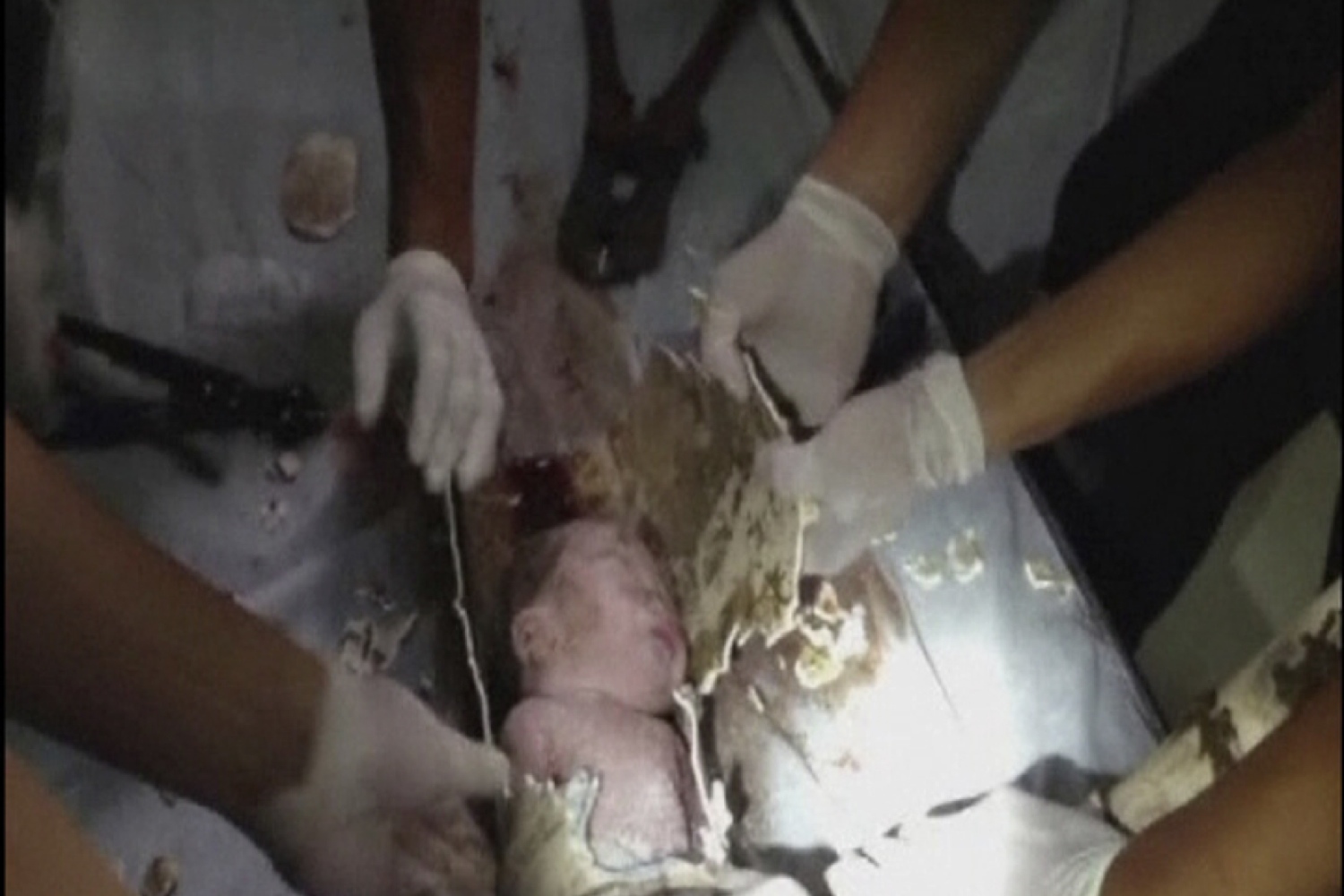 Firefighters and doctors rescue a baby by cutting away a sewage pipe piece by piece in Jinhua city